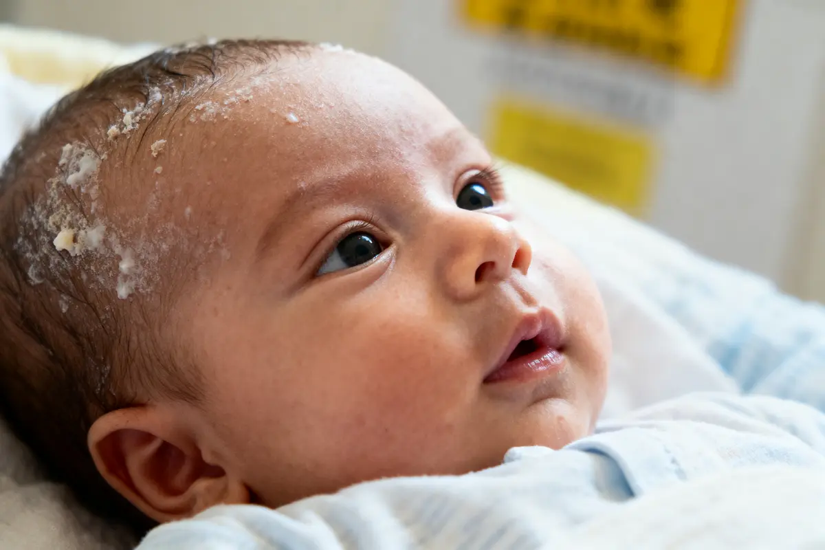 Bébé aux yeux expressifs avec croûtes de lait sur le cuir chevelu, regardant vers la droite.