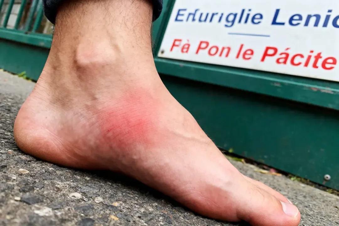 Cheville gonflée et rouge sur un trottoir, avec panneau flou en arrière-plan.