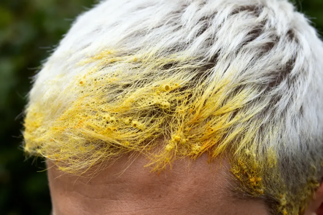 Cheveux blancs teintés de jaune par effet de la Bétadine