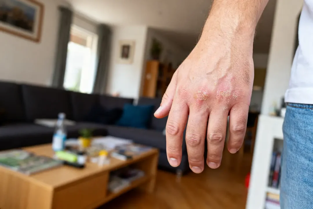 Main droite avec irritation dans un salon moderne et lumineux