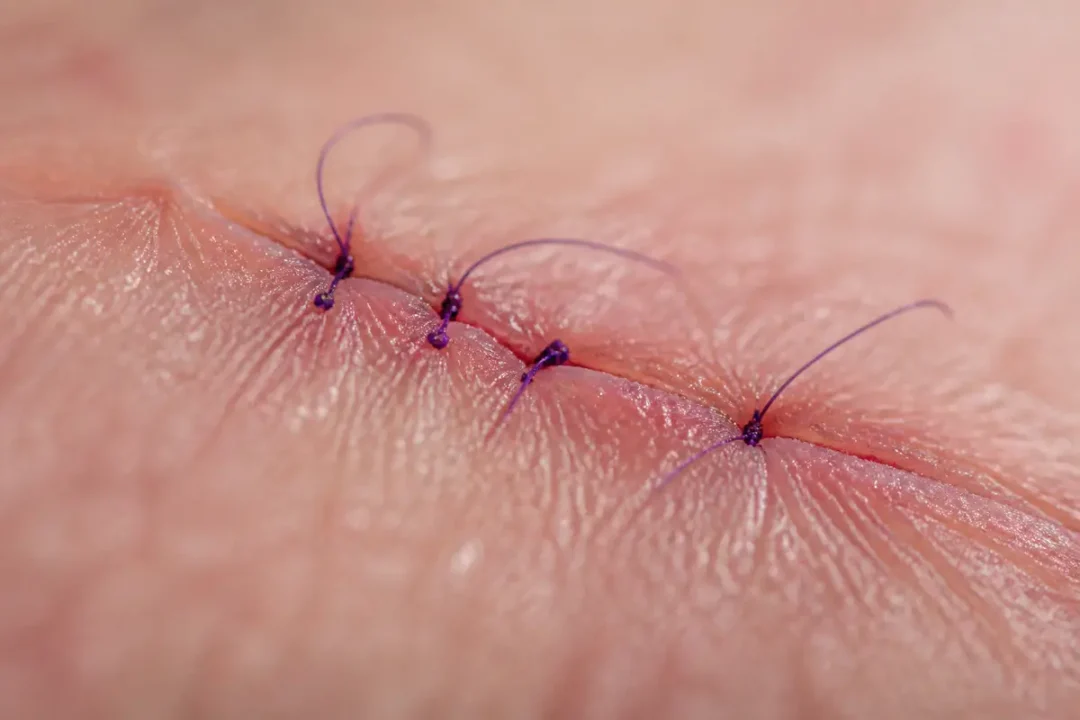 Gros plan d'une suture chirurgicale violette sur une peau humaine, avec trois points visibles.